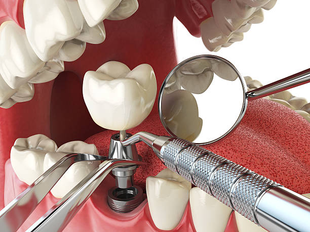 Best Emergency Tooth Extraction in Laurel Hollow, NY